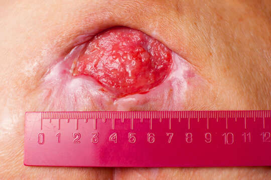 Close-up medical image of a severe stage 4 pressure ulcer (bedsore, decubitus ulcer) with granulation tissue and necrotic areas on human skin. Ruler used for wound size measurement.