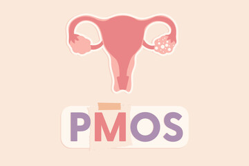 Minimalist flat vector design featuring the acronym PMOS with an anatomical diagram of the uterus and ovaries. © Gegambar