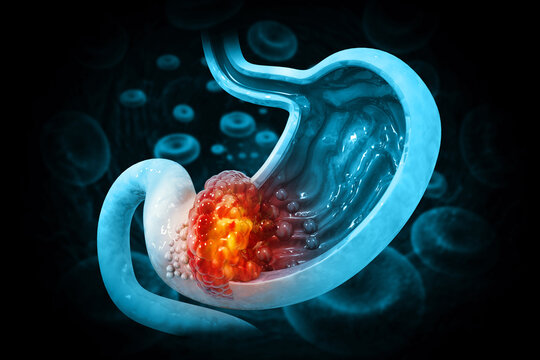 Gastric (stomach) cancer is a malignancy arising from the stomach lining, often caused by abnormal cell growth. 3d illustration