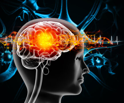 meningitis, serious inflammation of the protective membranes surrounding the brain and spinal cord. Virus or bacteria infection. 3d illustration
