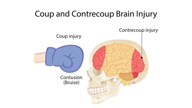 Coup and Contrecoup Brain Injury
Medical illustration showing coup and contrecoup brain injuries with cerebral contusions caused by traumatic head impact.