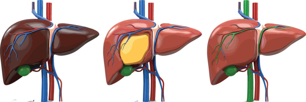 Human liver anatomy vector illustration set showing healthy liver fatty liver disease and medical internal organ structure with veins arteries and gallbladder