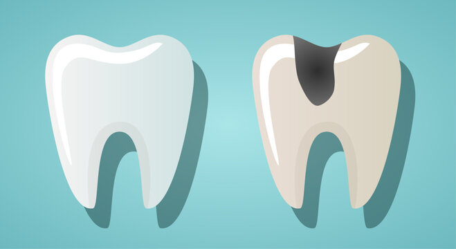 A healthy tooth and a tooth with caries. Vector illustration isolated on a blue background. Hand-drawn vector.