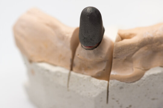Frames of ceramic-metal  crowns on the stand of the articulator