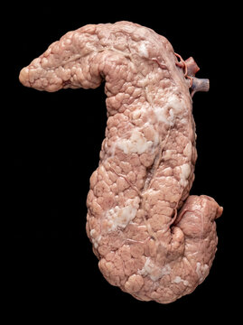 Raw pancreas anatomical specimen with a lumpy, convoluted surface texture, light pink-beige color, and visible blood vessels on a black background.