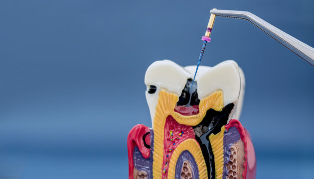 Endodontic root canal treatment concept: tweezers inserting a dental file into a cross-section tooth model with deep caries.