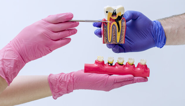 Dentist pointing at root canal and nerve on a detailed anatomy model showing severe decay and bone. Endodontics and pulpitis concept.