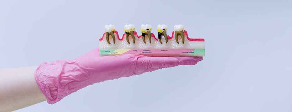 Dentist hand holding a periodontal disease model. Stages of gingivitis and periodontitis anatomy concept.