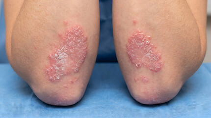 Naklejka premium Close up of elbows with red, scaly patches indicating a skin condition like psoriasis