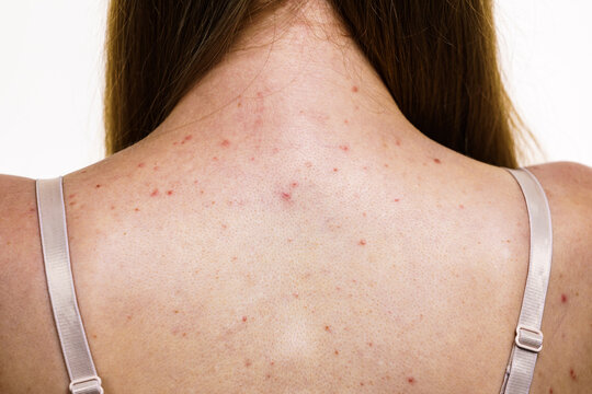 Woman with skin problem acne on back