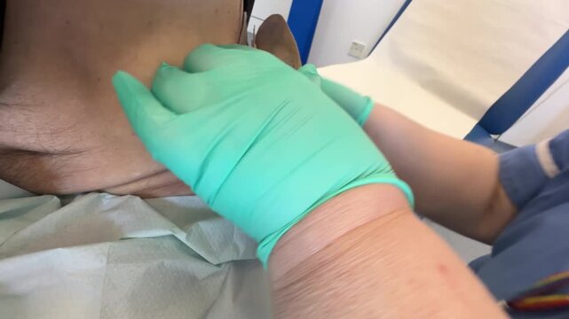 Nurse removing used nephrostomy bag from man's body, kidney drainage; close up shot.