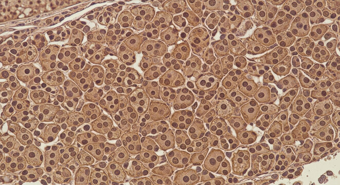 Histological tissue sample with dense cellular arrangement, brown staining pattern histology cells