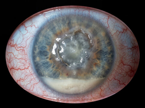 Severely inflamed human eye with corneal ulcer and hypopyon, showing red blood vessels and discolored iris, isolated on black background.