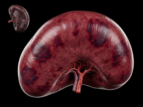 3D render of enlarged, discolored human spleen with dark red, irregular surface texture and visible blood vessels, isolated on black background.