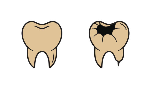 Dental caries progression illustration featuring healthy tooth beside damaged molar with large black cavity and root infection.