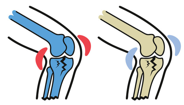 Conceptual illustration of two knees, one healthy with intact bone structure and cartilage, another with a cracked bone.