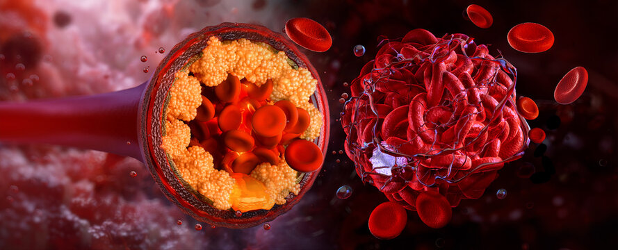 Atherosclerosis in artery cross section with cholesterol plaque buildup and blood clot formation, 3D medical illustration. Blocked blood vessel, thrombosis, reduced blood flow, cardiovascular disease