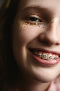 Close-up portrait of a smiling girl with dental brace and glitter