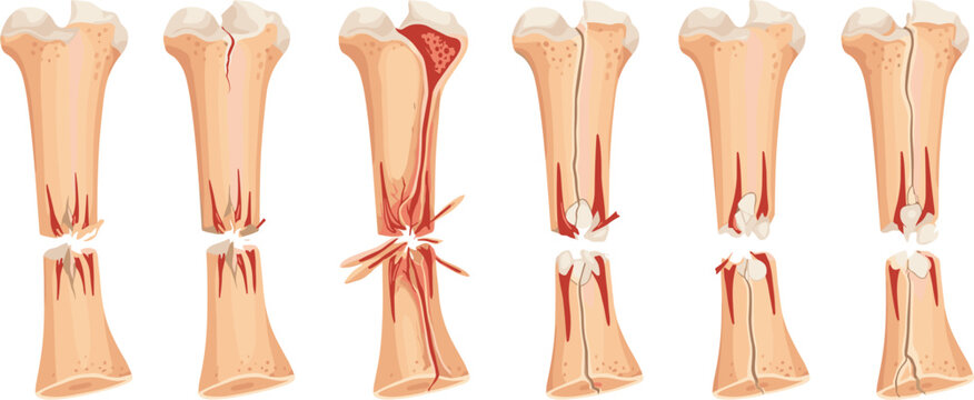 Broken bone fracture vector set with medical injury stages, cracks, blood vessels, and orthopedic anatomy illustrations