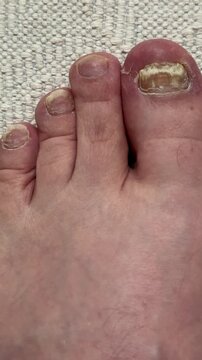 Onychomycosis of toenails by a patient. A dangerous fungal infection of toenails in a person. Disease and detachment of the nail plate. Regular cleaning and inspection