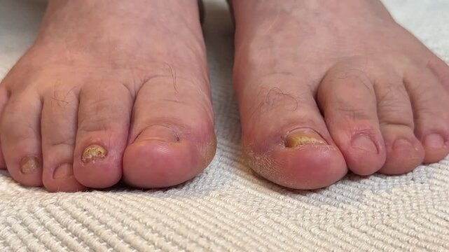 Onychomycosis of toenails by a patient. A dangerous fungal infection of toenails in a person. Disease and detachment of the nail plate. Regular cleaning and inspection