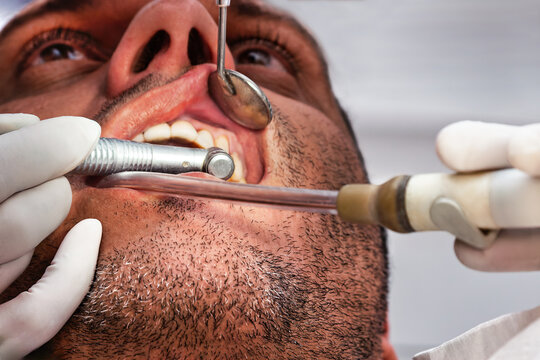 Patient undergoing dental treatment with handpiece and suction tool in clinic