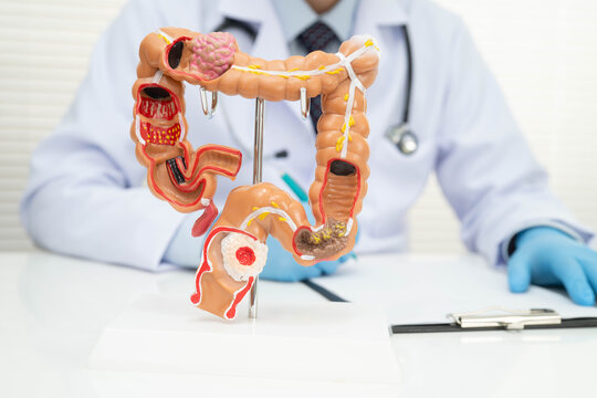 Colorectal cancer, doctor holding intestine colon human anatomy model.