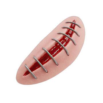 Surgical Wound with Sutures