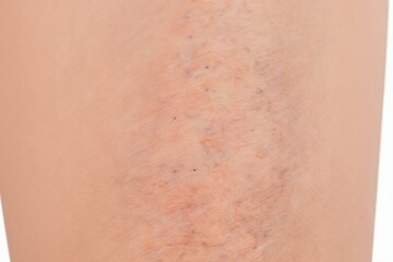 Fototapeta premium Close up of womans leg showing visible varicose spider veins and redness on skin surface. Medical condition of damaged blood vessels causes swelling and discomfort.