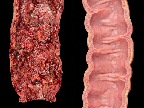 Large intestine gross pathology comparison: severe ulcerative colitis with pseudopolyps and hemorrhage (left) and normal healthy colon mucosa (right) on black background.