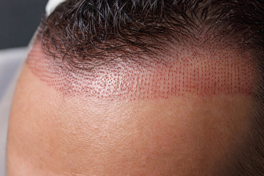 Medium shot of full hairline restoration area immediately after hair transplant surgery.