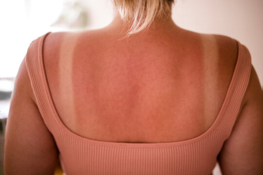 Female with sunburned skin showing tan lines on back, wearing a pink sleeveless top, indoor setting with soft lighting and blurred background elements