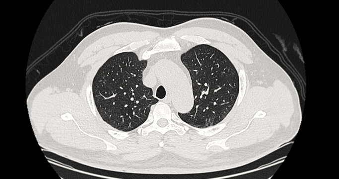 Axial CT scan of a normal, healthy human thorax showing clear lungs, heart, and intact anatomical structures. Perfect for medical reference, healthcare education, and clinical concepts.