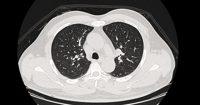 Axial CT scan of a normal, healthy human thorax showing clear lungs, heart, and intact anatomical structures. Perfect for medical reference, healthcare education, and clinical concepts.