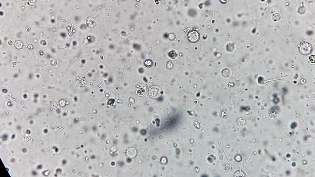 Oligozoospermia and asthenozoospermia with evidance of infection. Plenty of pus cells are seen. Microscopic footage of abnormal sparm count.
