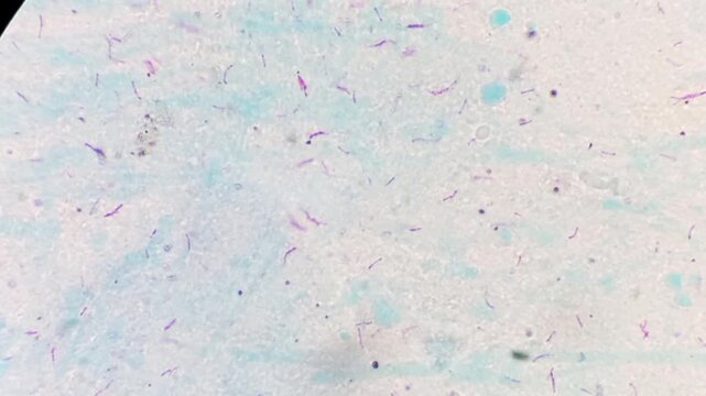 Sputum smear AFB stain microscopic footage plenty of mycobacterium tuberculosis bacteria. Acid Fast Bacilli (AFB) positive (4+).
