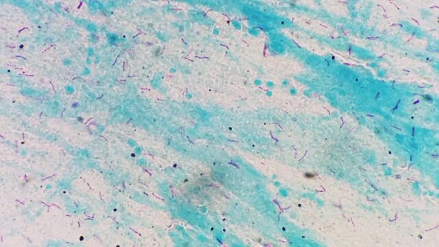 Sputum smear AFB stain microscopic footage plenty of mycobacterium tuberculosis bacteria. Acid Fast Bacilli (AFB) positive (4+).