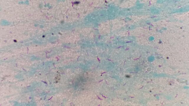 Sputum smear AFB stain microscopic footage plenty of mycobacterium tuberculosis bacteria. Acid Fast Bacilli (AFB) positive (4+).