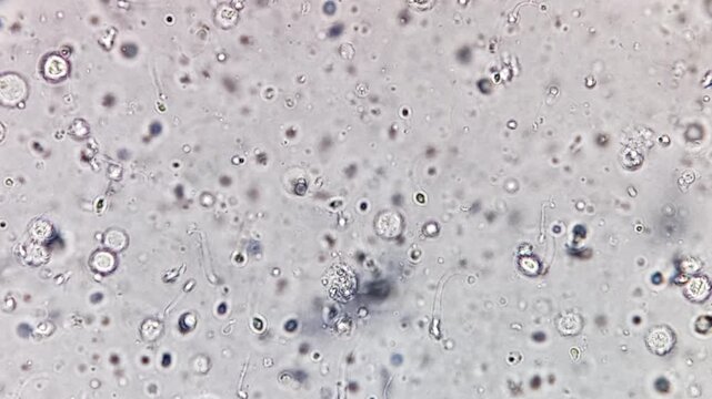 Oligozoospermia and asthenozoospermia with evidance of infection. Plenty of pus cells are seen. Microscopic footage of abnormal sparm count.