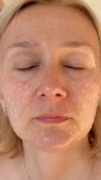 Female cosmetologist in papules after mesotherapy