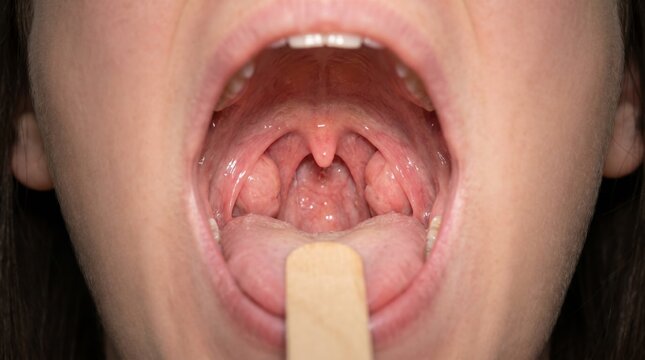 Healthy tonsils in adult female open mouth from clinical frontal view