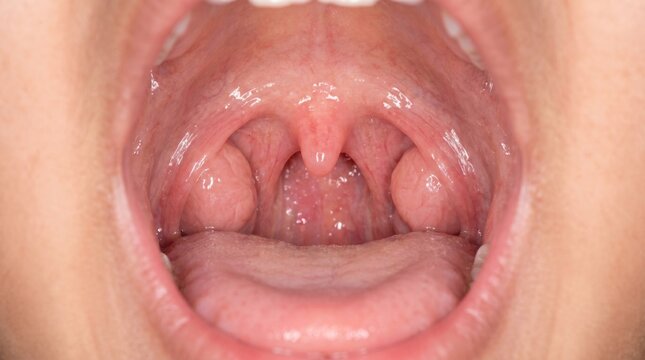 Normal large healthy tonsils in a young South Asian child's open mouth