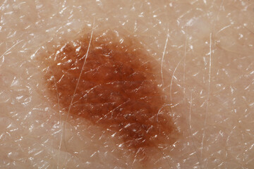 Fototapeta premium Macro view of skin with birthmark as background