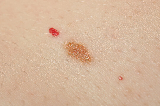 Macro view of skin with birthmarks as background