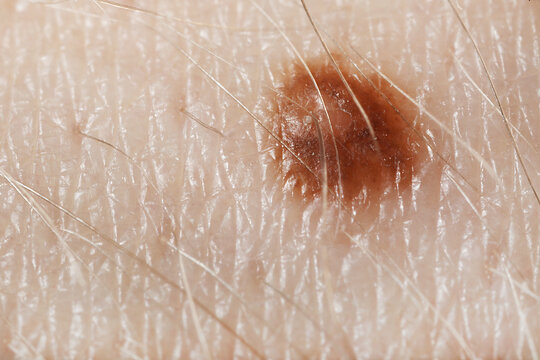 Macro view of skin with birthmark as background