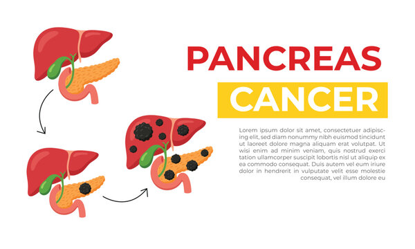 Pancreatic cancer stages, pancreas disease