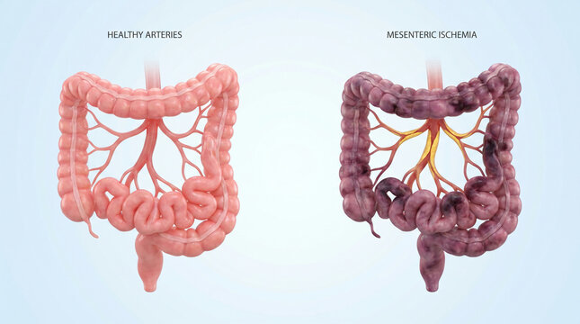 Acute mesenteric ischemia bowel infarction medical illustration