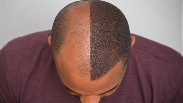 Before and After Scalp Micropigmentation Treatment for Hair Loss: Top View of Man's Head Showing Thinning Hair vs. Dense Results for Baldness Correction and Hair Density