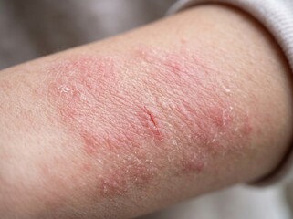 Fototapeta premium Close-up of child's arm with eczema rash