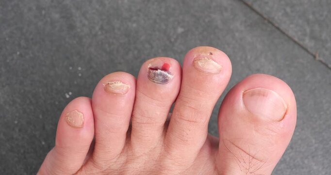 Cinematic close-up of a bruised toenail with subungual hematoma trauma, blood under the middle toe nail injury concept